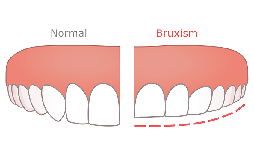 Teeth-Grinding: Get Help for Pain and Discomfort